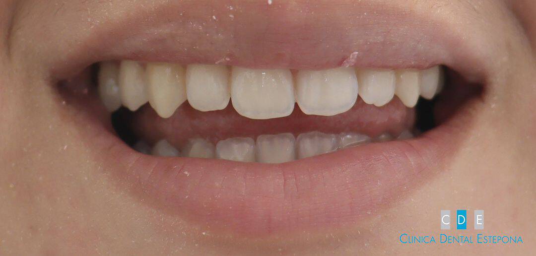 Teeth Brightening — Before
