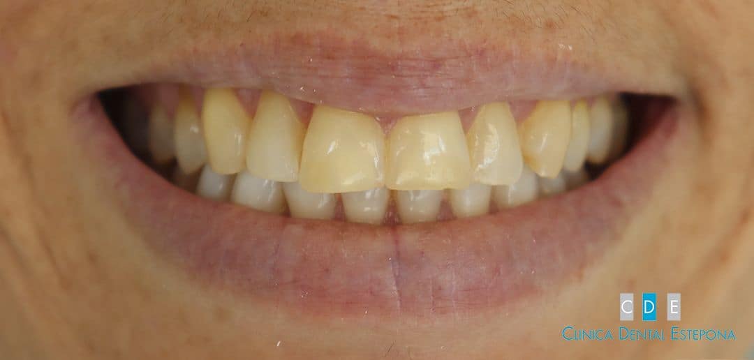 Porcelain Veneers — Before