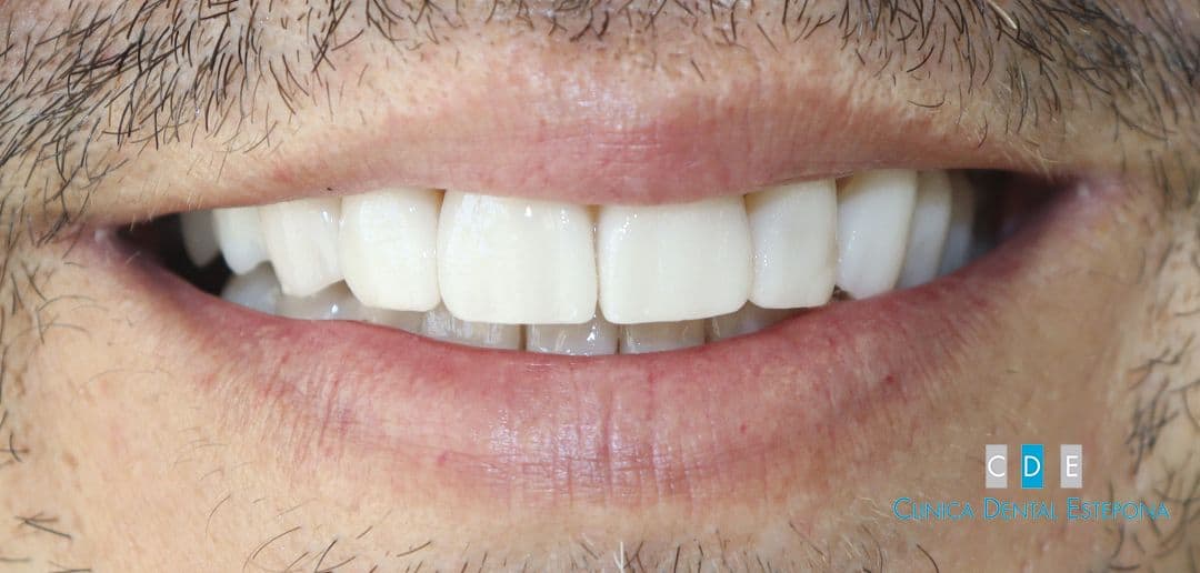 Porcelain Veneers — After
